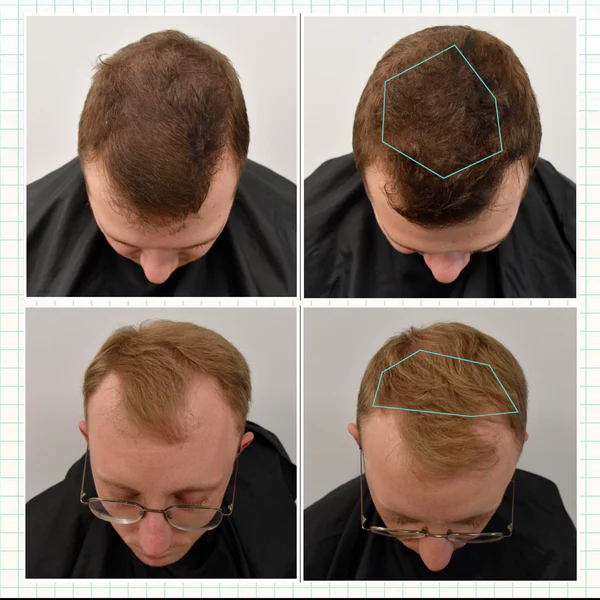 Ulti Paris Терапия против косопад с подарък дермаролер 16