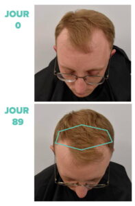 Ulti Paris Терапия против косопад с подарък дермаролер 18 ulti-paris-research-results